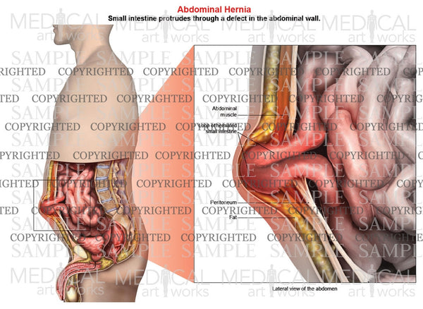 Abdominal Hernia Anatomy Of Male Lateral View Medical Art Works