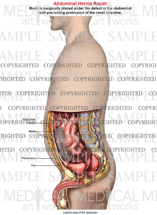 abdominal hernia in women