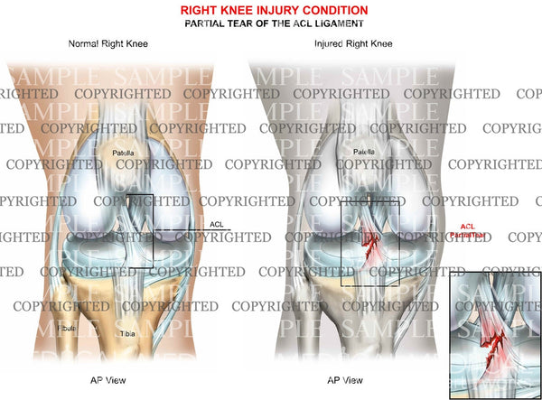 Right knee tear — Medical Art Works