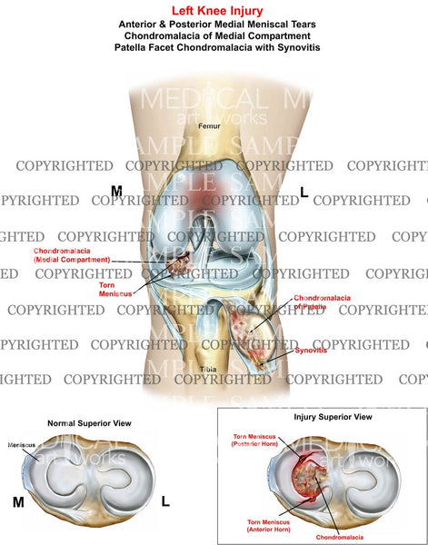 Left Knee Injury Anterior And Posterior Medial Mensicus