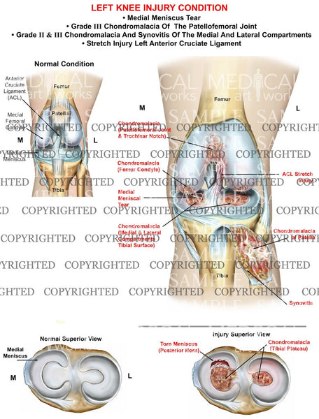 knee compartments