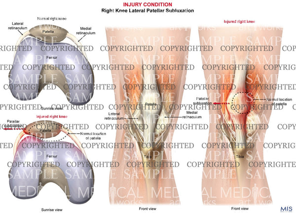 patellar subluxation