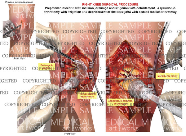 Arthrotomy