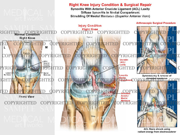 Right Knee Arthroscopic Surgical Procedure Of Synovitis Acl Laxity And