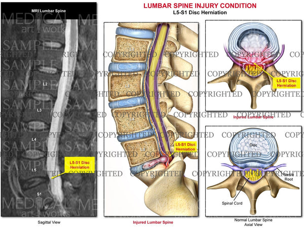 L5S1 Lumbar spine disc herniation with MRI — Medical