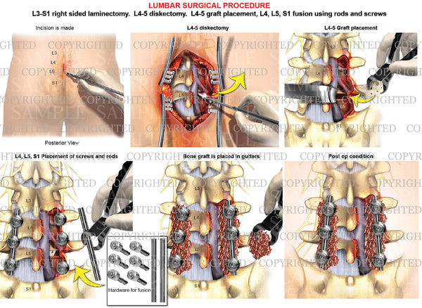 L5 S1 Posterior Lumbar Interbody Fusion Plif Stock Trial Exhibits 