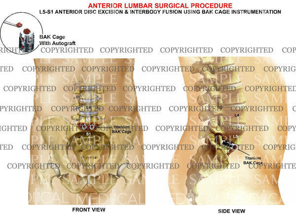 Anterior posterior lumbar fusion l5 s1