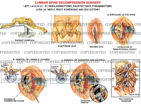 L45, L5S1 Lumbar spine surgery — Medical