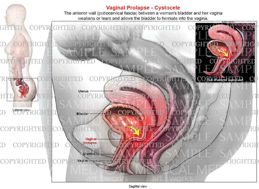 Vaginal Prolapse - Cystocele (fallen bladder) – Medical Art Works