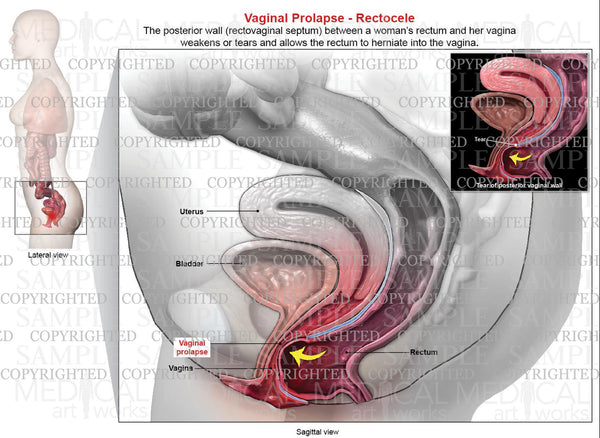 Prolapse Art