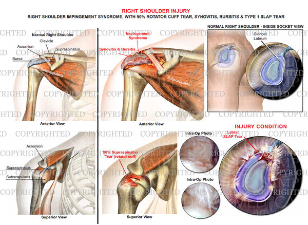 right scapula tear