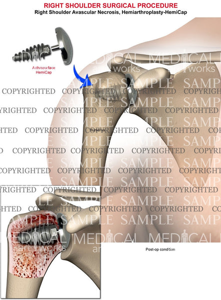 Right Shoulder Hemiarthroplasty (HemiCap) — Medical Art Works