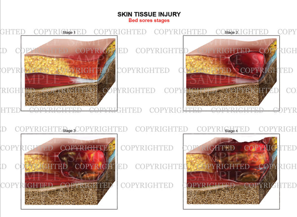 bed-sores-classification-chart-medical-art-works