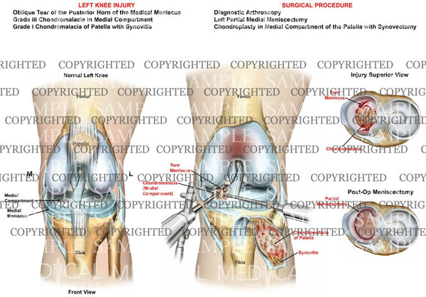 knee compartments chondromalacia