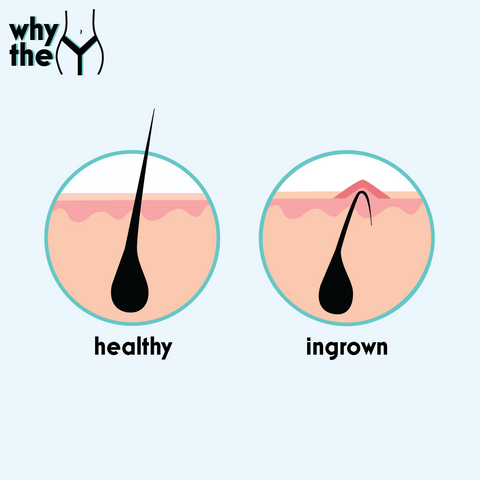 #WhytheY Part 3: Ingrown Hairs! – JAYJUN USA OFFICIAL