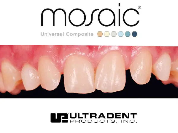 Ultradent Mosaic restoration before Anterior Restoration