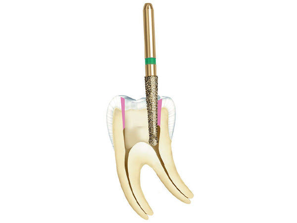 a graphic example of an endo access done with the 15802 bur