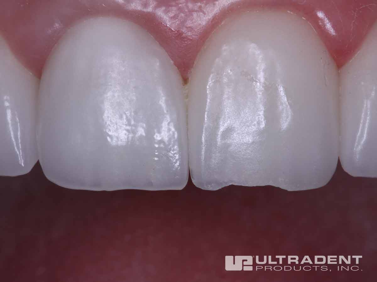 Before Ultradent Porcelain Repair