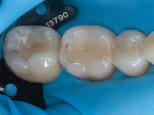 With rubber dam in place (Clinician's Choice True Dental Dam), pre-op view of wide Class II on first molar requiring replacement.