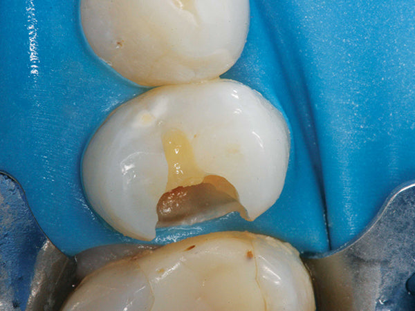 Deep Class II pre-molar preparation.