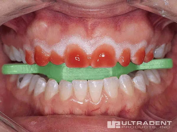 bite block orthodontics