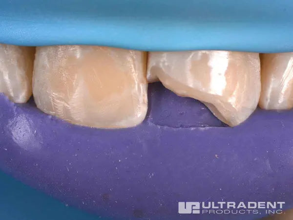 Ultradent Mosaic Restoration Procedure