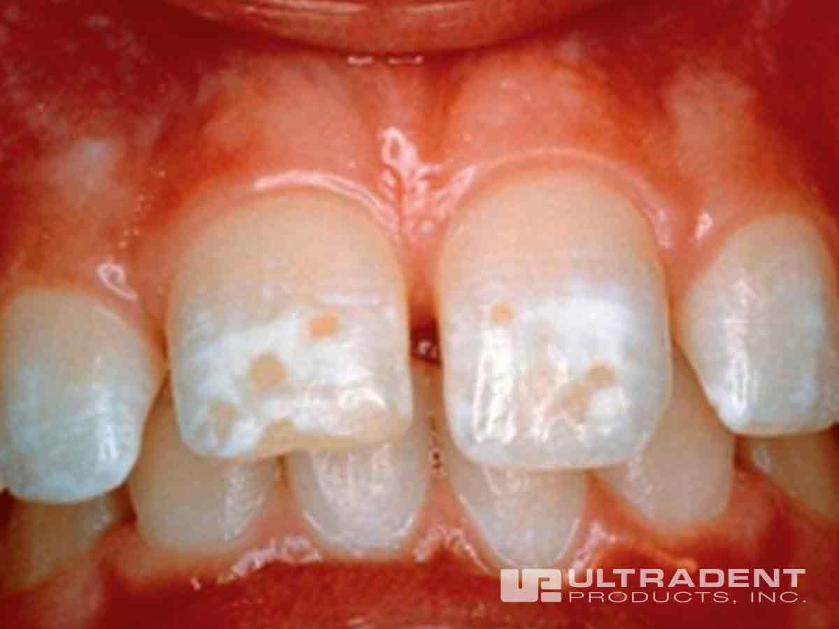 Before application of Opalustre