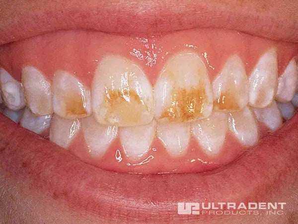 Teeth prior to application of Opalustre