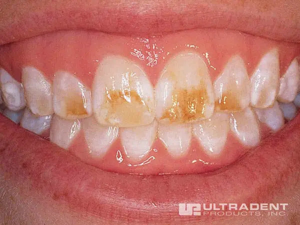 Dents avant application d'Opalustre
