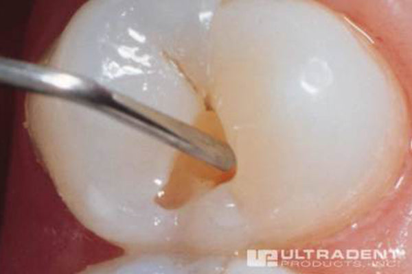 Fill restoration with flowable PermaFlo composite