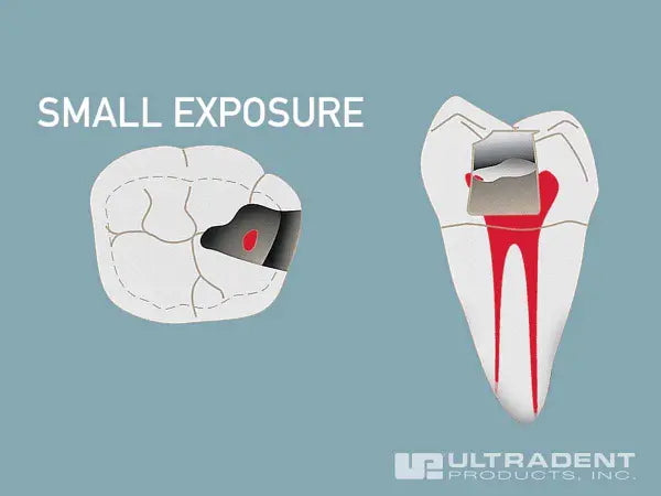 small nonhyperemic exposure