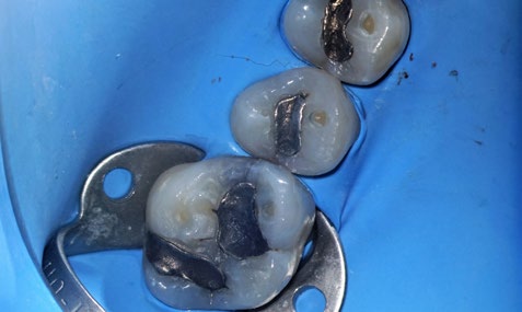 maxillary second premolar