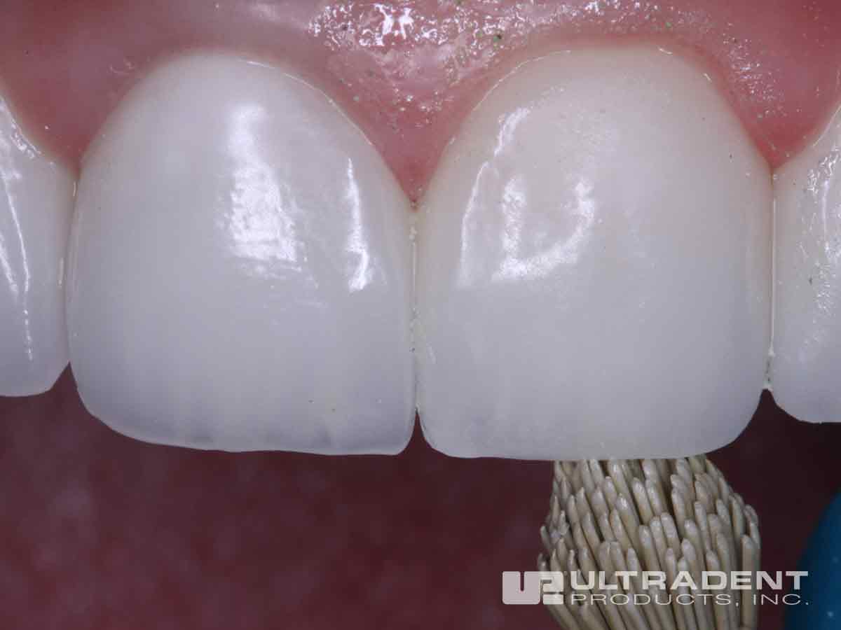 After Ultradent Porcelain Repair