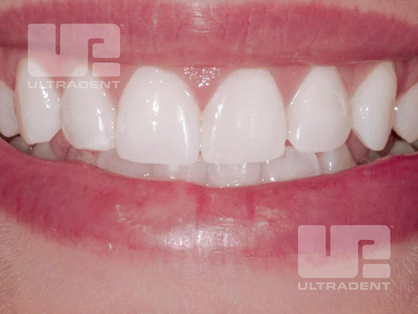 After whitening with Opalescence Boost