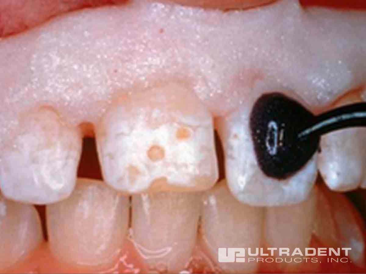 Isolate mottled teeth with OpalDam resin barrier