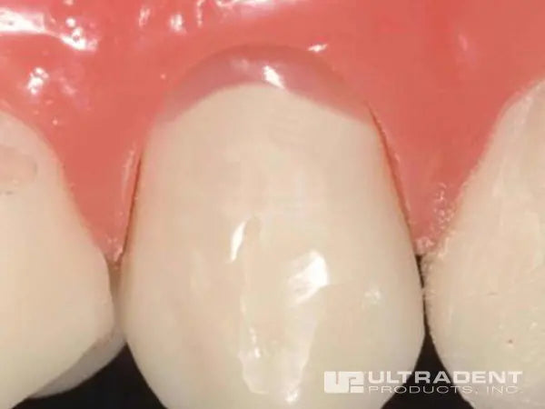 Resultant restoration can mask white root surfaces