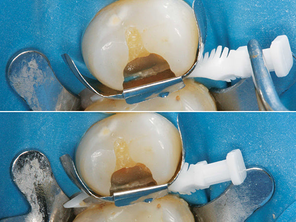 The Active-Wedge tip collapses during insertion for easy placement, then re-expands when fully seated, regaining full contour for an improved matrix band seal.