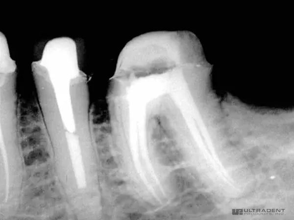 EndoREZ™-Root Canal Sealer