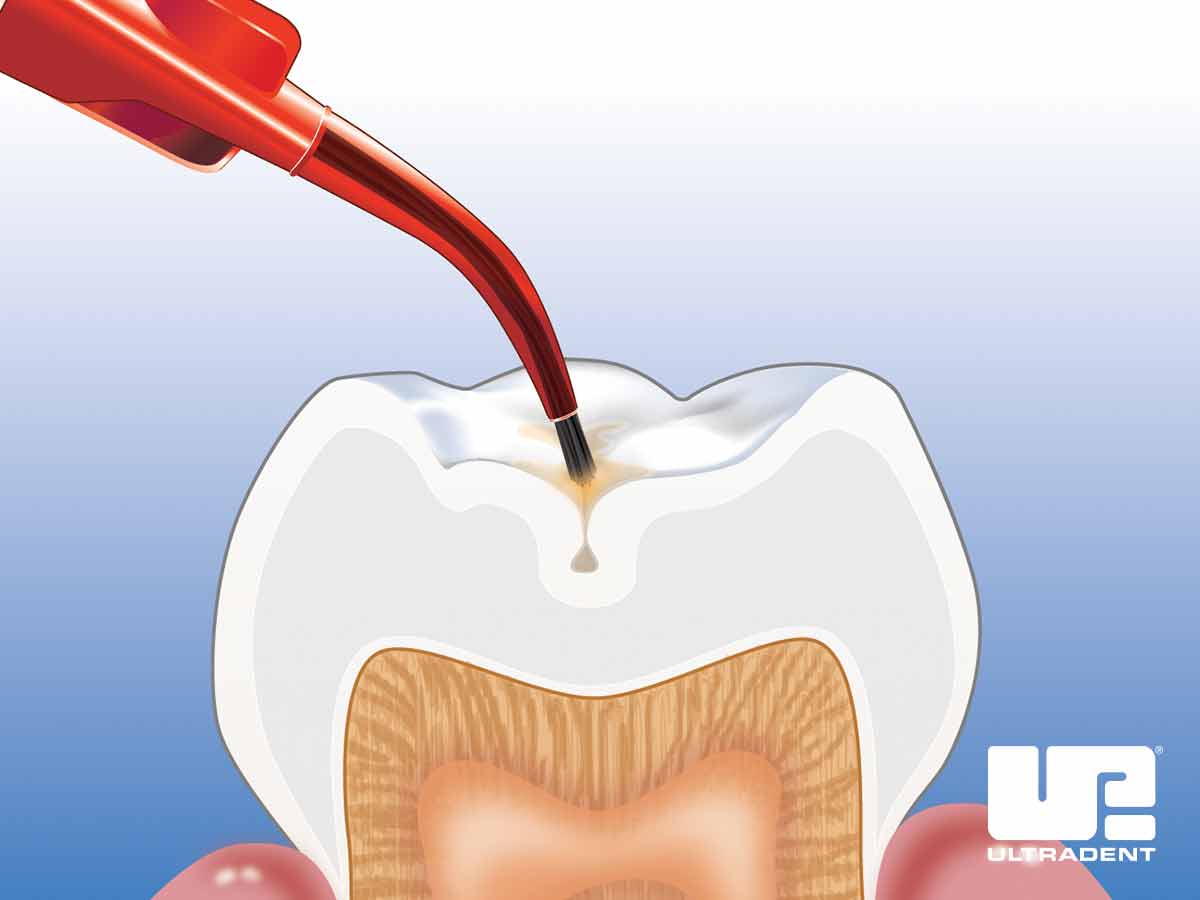 Place UltraSeal XT Hydro Sealant on the tooth