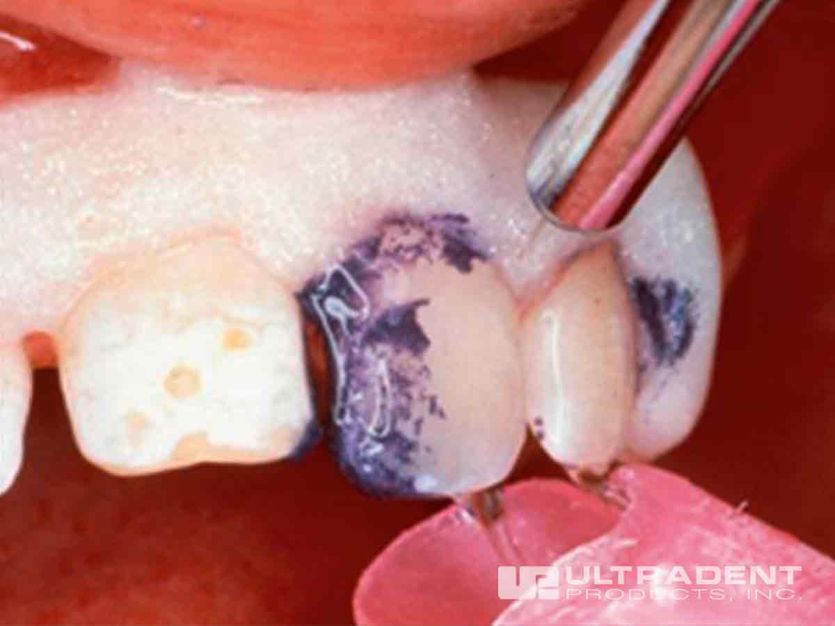 Remove Opalustre slurry with an air/water spray.