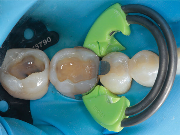 First increment of Evanesce Restorative material adapted to include Ultra-Wrap's pre-contoured occlusal lip, establishing an ideal rolling marginal ridge.
