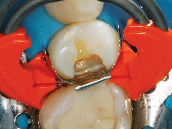 Once seated, the DualForce Sectional Matrix System provides a complete gingival seal with a tight vertical seal of the matrix band along with a strong and stable separation force, resulting in less chance of composite flash.