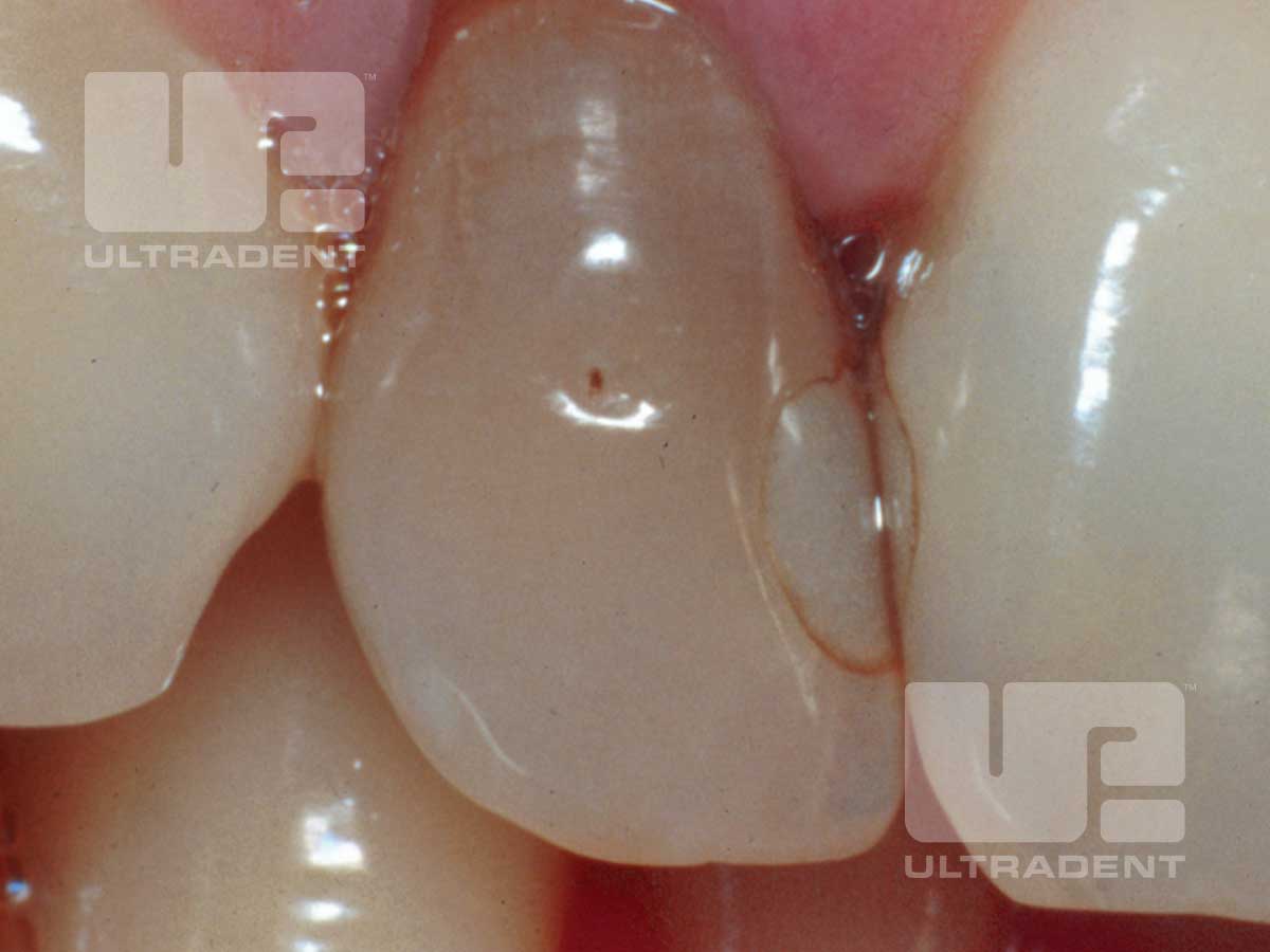 Opalescence Endo patient teeth before