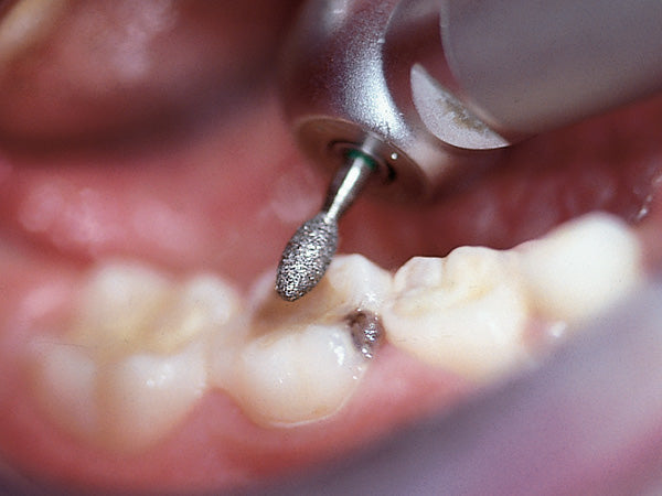 6379 diamond bur clinical application