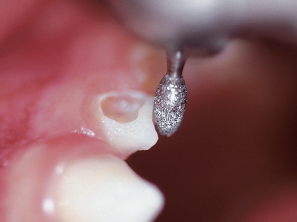 6379 diamond bur example of clinical application