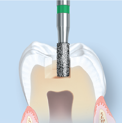 Komet 6835 Clinical Technique