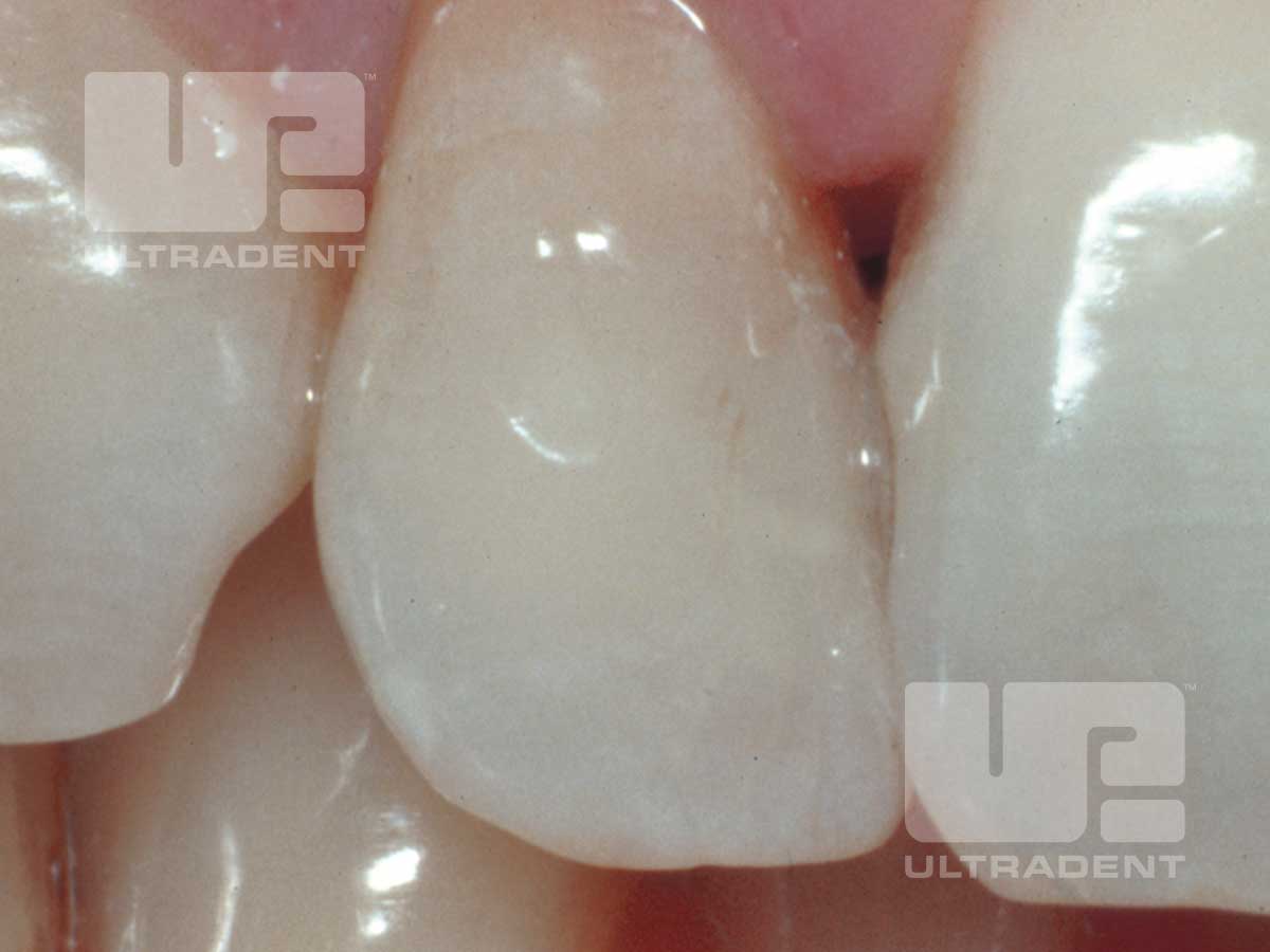 Opalescence Endo patient teeth after