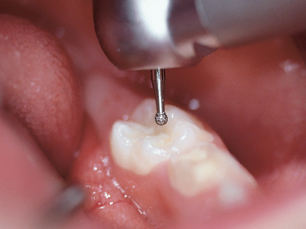 801 diamond bur in a patient's mouth