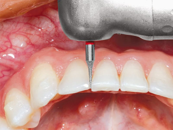 Technique clinique de parage interproximal Komet avec la fraise diamantée à aiguille 8392