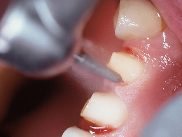 Komet 856P Crown Preparation Diamond Bur in use